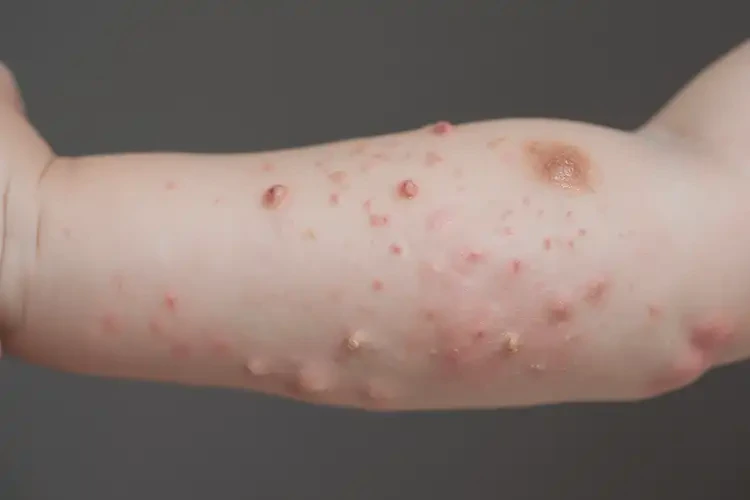 幼兒手臂上有濕疹能靠自己自愈嗎(圖4)