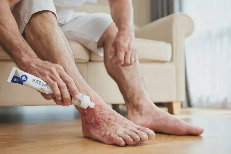 男人腳上長濕疹能不能根治(圖2)