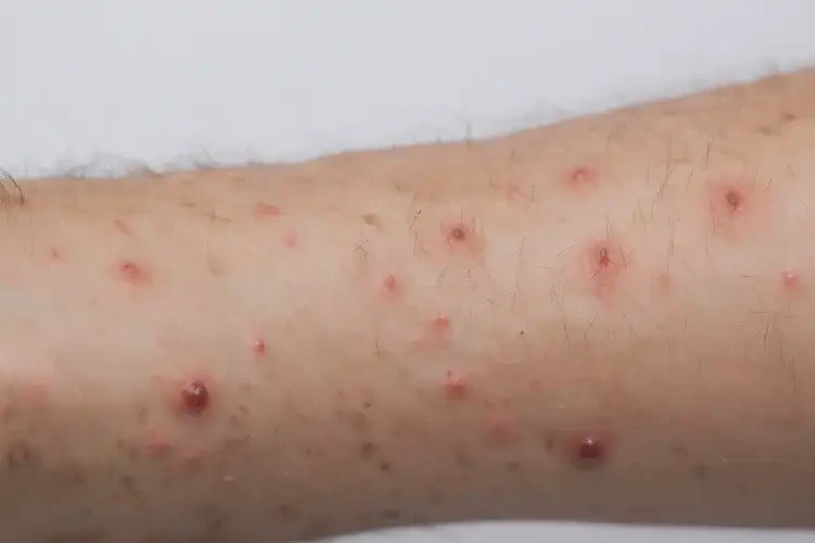 青年人四肢偶爾長濕疹不管它會自己痊愈嗎(圖4)