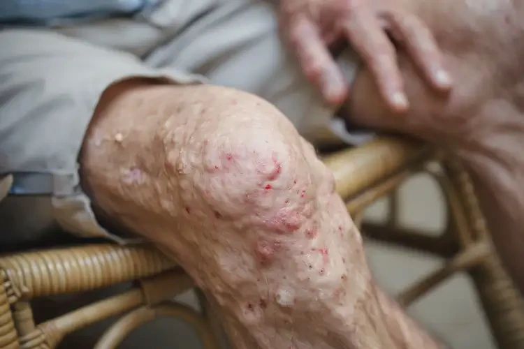 老年人大腿上長濕疹不管它會自己痊愈嗎(圖4)