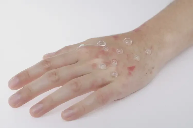 女生手上容易起湿疹不管它会自己自愈吗(图2)