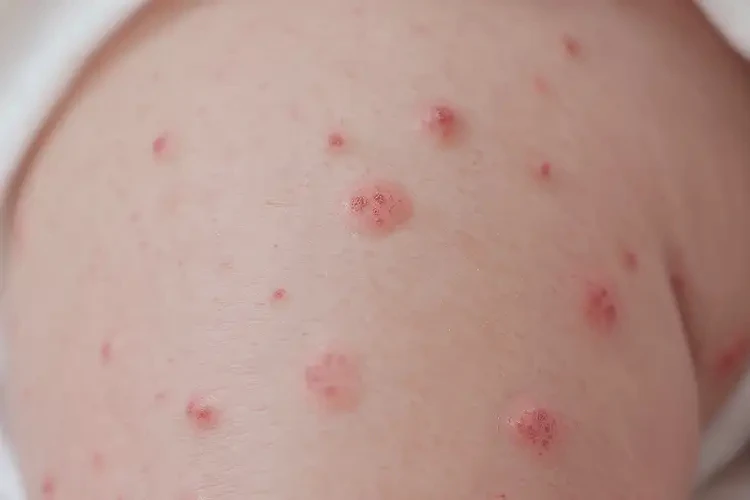 新生儿大腿上偶尔起湿疹能彻底自愈吗(图4)