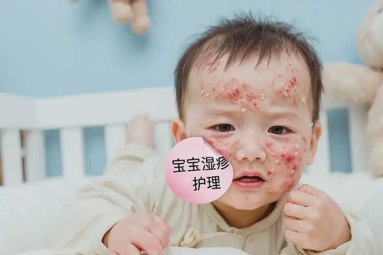 嬰兒臉上經常起濕疹不管它會自己好嗎(圖4)