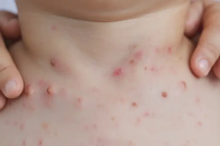 孩子脖子上起濕疹可不可以徹底自愈(圖4)