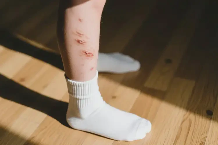 中學生小腿上經(jīng)常起濕疹可不可以徹底自愈(圖2)