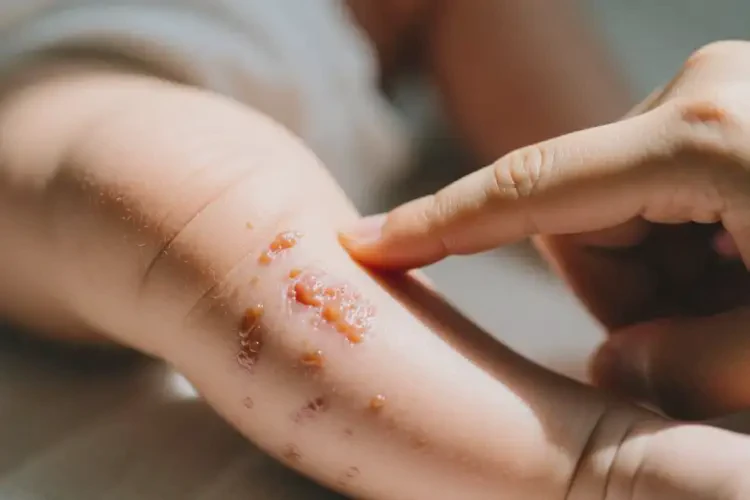 嬰幼兒小腿經(jīng)常長濕疹不管它會(huì)自己好嗎(圖2)