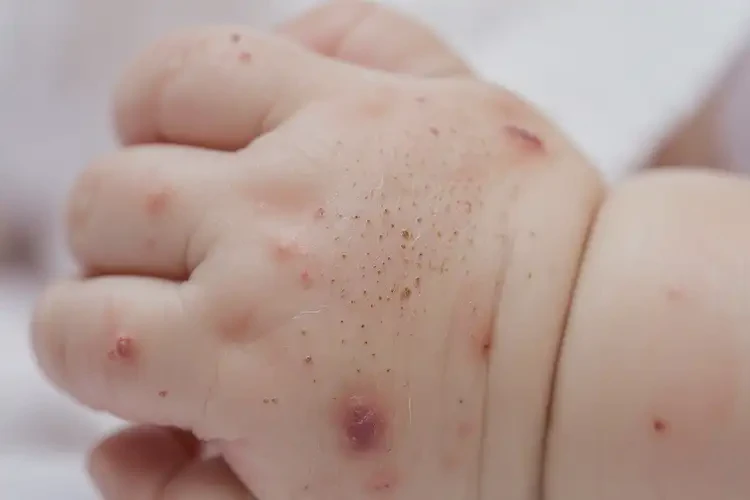 嬰兒手上出濕疹能徹底自愈嗎(圖4)