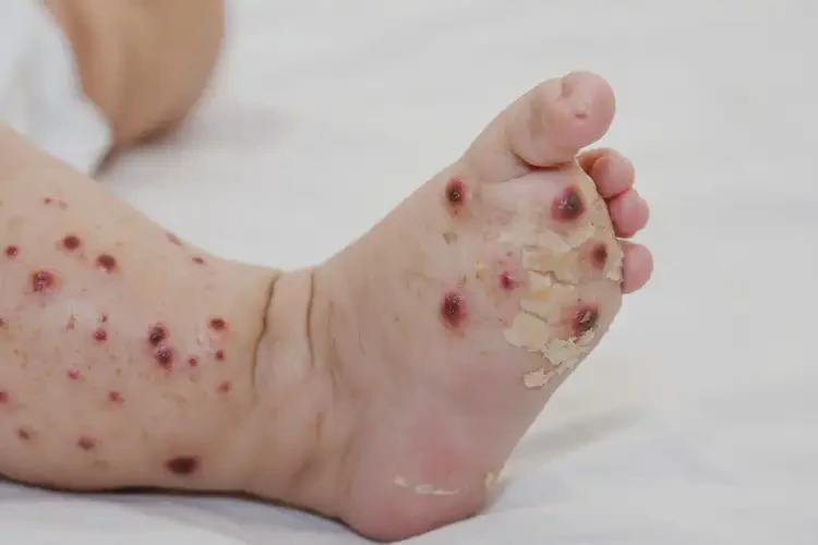 婴儿小腿上经常长湿疹能靠自己自愈吗(图3)