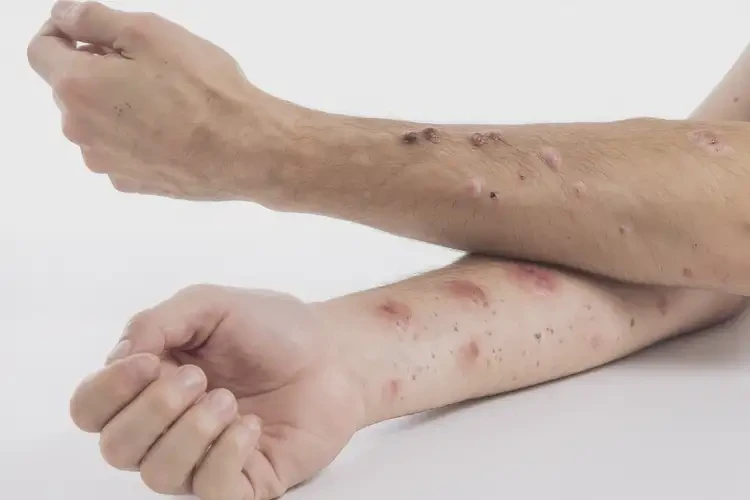 男生手臂上經(jīng)常長濕疹能徹底自愈嗎(圖3)