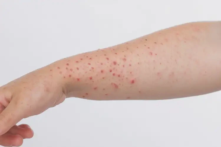 小孩手臂上容易長濕疹不管它會自己自愈嗎(圖3)