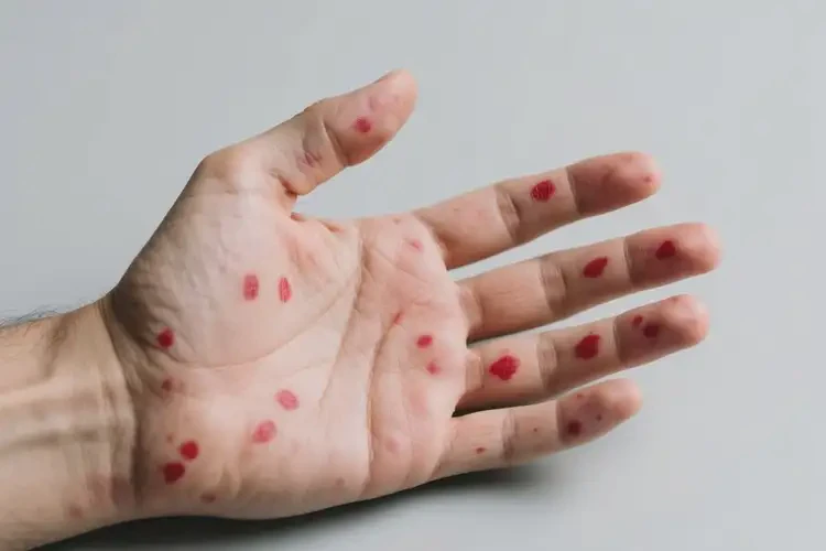 男生手上偶爾起濕疹不管它會(huì)自己好嗎(圖1)