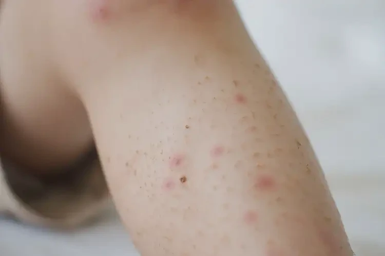 小兒大腿上偶爾長(zhǎng)濕疹可以徹底自愈嗎(圖4)