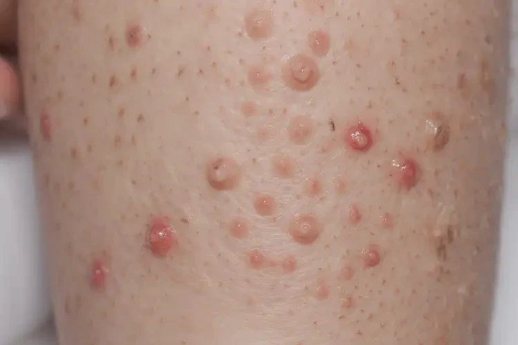 小孩小腿上偶爾起濕疹可不可以根治(圖4)