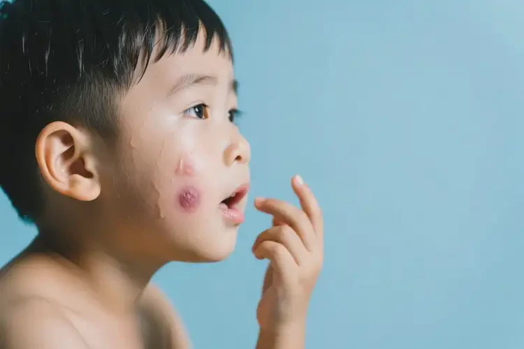 孩子臉上有濕疹不管它會(huì)自己痊愈嗎(圖2)