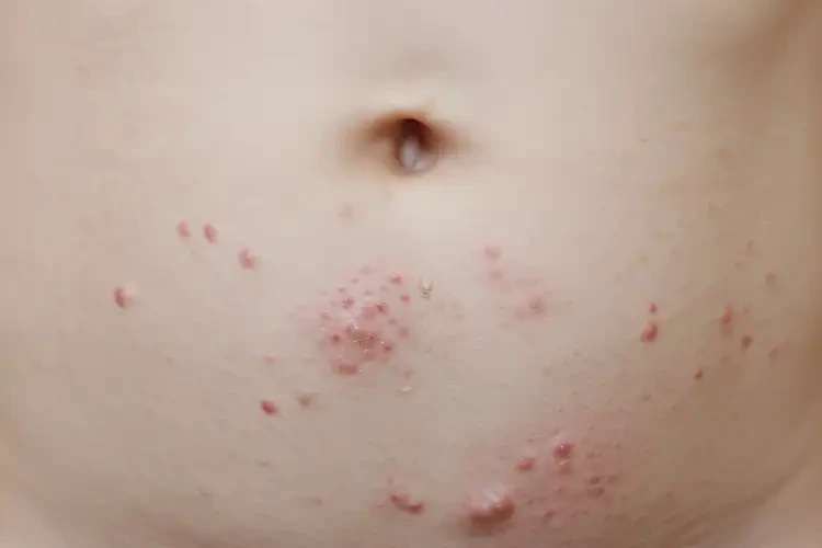 少兒肚子長濕疹可不可以根治(圖4)