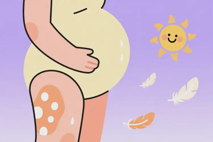 孕婦小腿上有濕疹能靠自己自愈嗎(圖1)