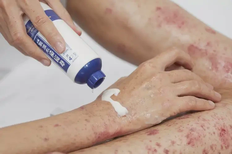 男生全身容易起濕疹能夠徹底治愈嗎(圖4)