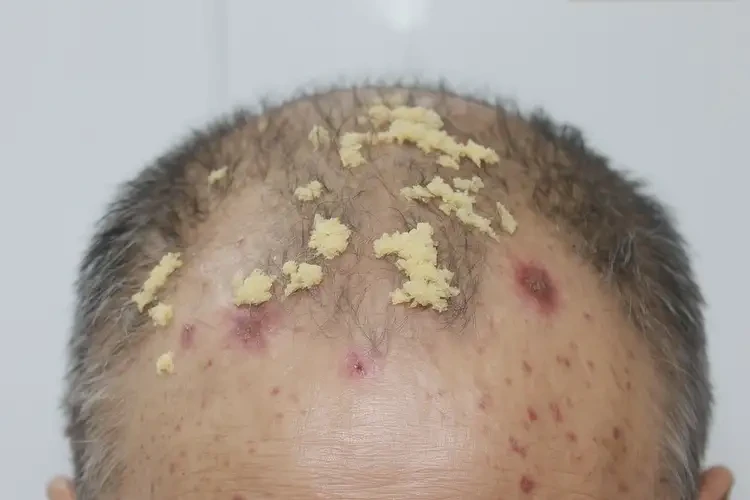 大學生四肢出現(xiàn)濕疹可不可以徹底自愈(圖2)