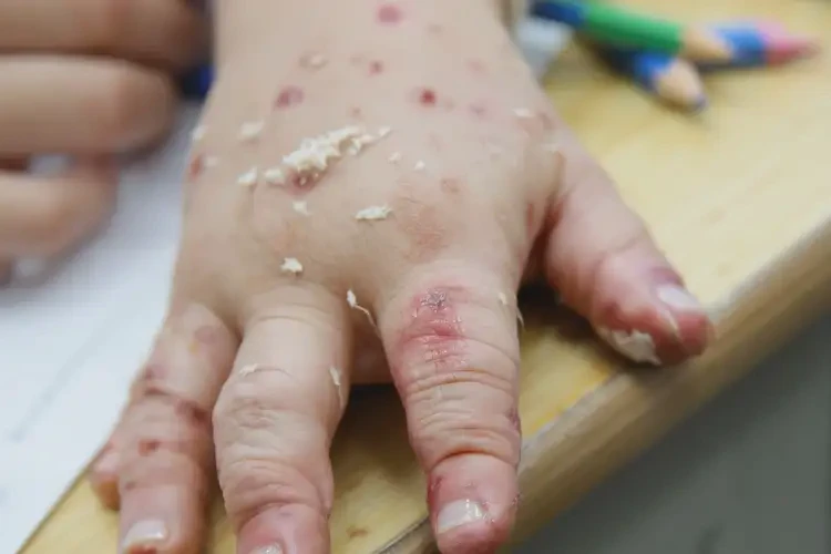 小學(xué)生手上出濕疹能靠自己自愈嗎(圖4)