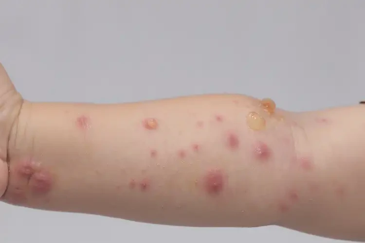 孩子身上偶爾起濕疹不管它會自己痊愈嗎(圖3)