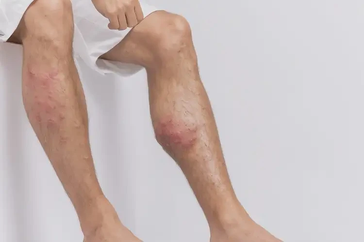 青年人大腿上偶爾長(zhǎng)濕疹可不可以徹底自愈(圖4)