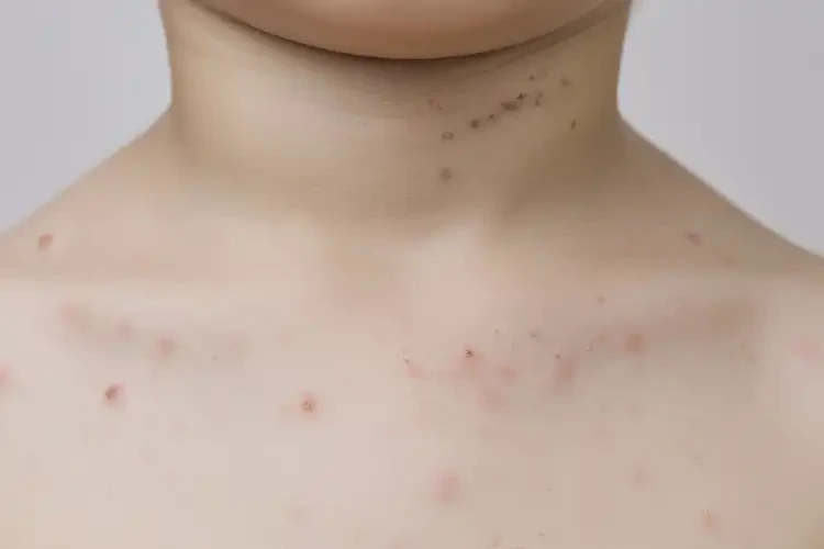 兒童脖子上偶爾長濕疹能徹底自愈嗎(圖4)