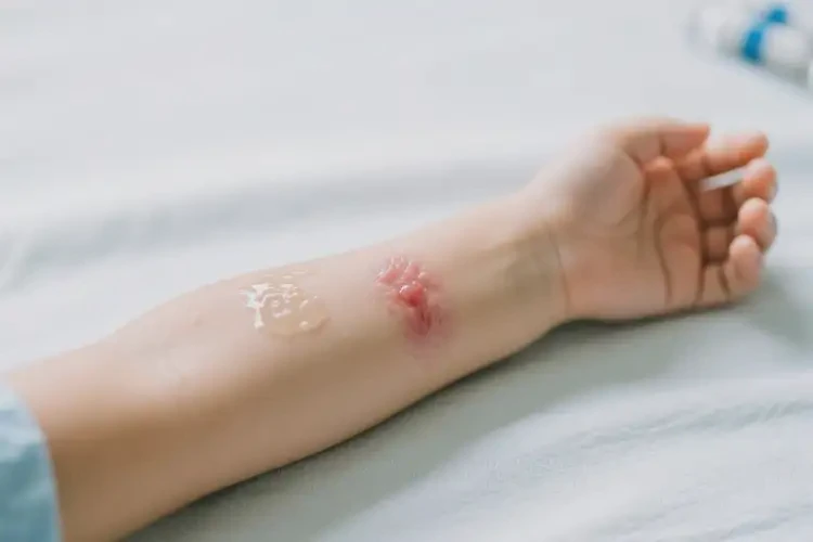 小孩手臂有濕疹不管它會自己自愈嗎(圖3)