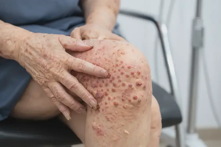 女性大腿上有濕疹不管它會自己痊愈嗎(圖4)