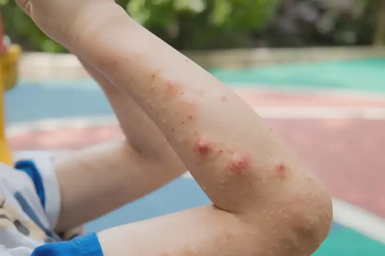 小儿四肢偶尔长湿疹不管它会自己痊愈吗(图3)