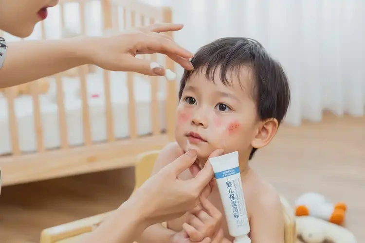 幼兒臉上經常長濕疹不管它會自己好嗎(圖3)