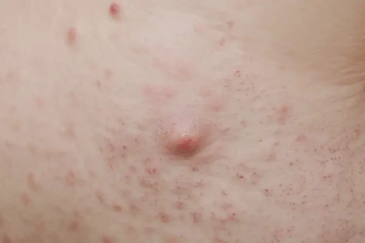 青少年肛周偶爾起濕疹能靠自己自愈嗎(圖4)