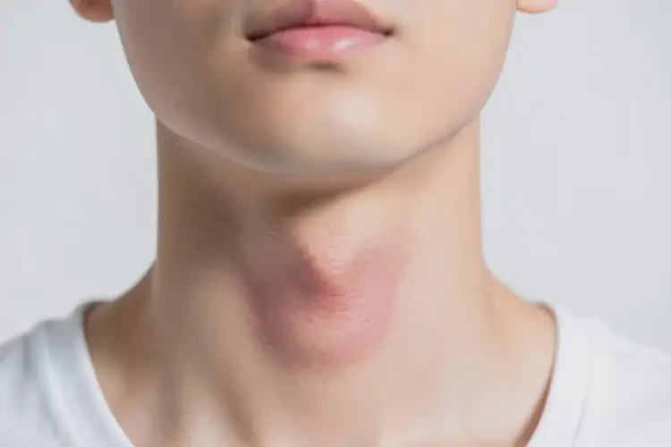 男人脖子上容易長(zhǎng)濕疹能不能徹底自愈(圖4)