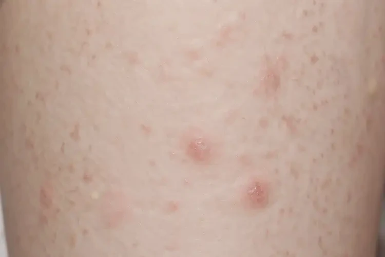 大學(xué)生小腿上出濕疹不管它會(huì)自己痊愈嗎(圖4)