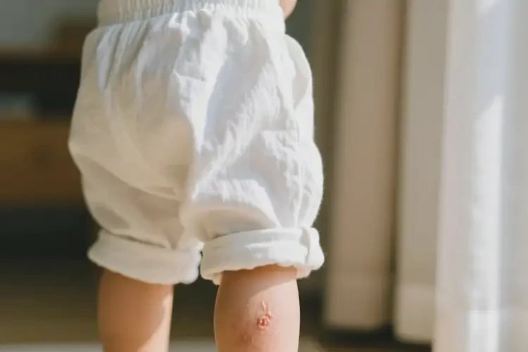 幼儿小腿经常起湿疹可不可以彻底自愈(图2)