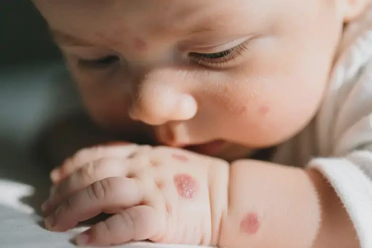 新生兒身上偶爾長濕疹不管它會自己自愈嗎(圖1)