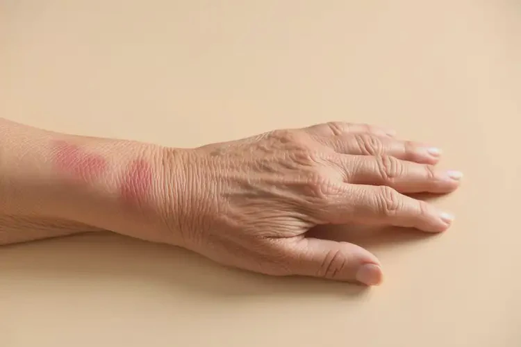 高齡老人手臂上偶爾起濕疹能不能根治(圖4)