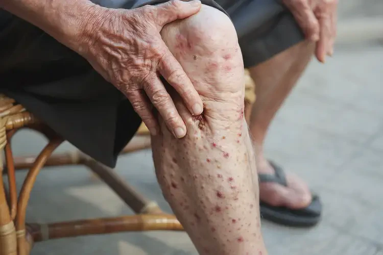 高齡老人小腿上起濕疹能不能根治(圖4)