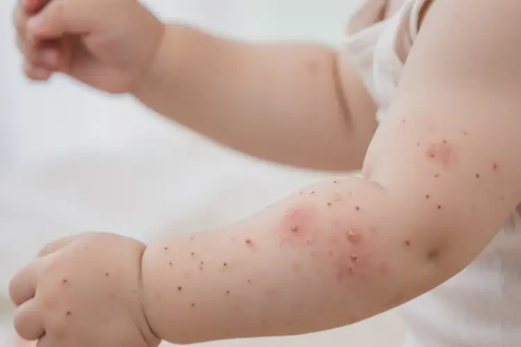 幼兒手臂起濕疹不管它會自己好嗎(圖4)