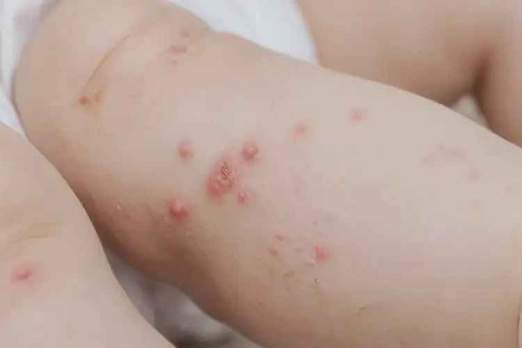 孩子小腿上偶爾起濕疹能夠徹底治愈嗎(圖4)