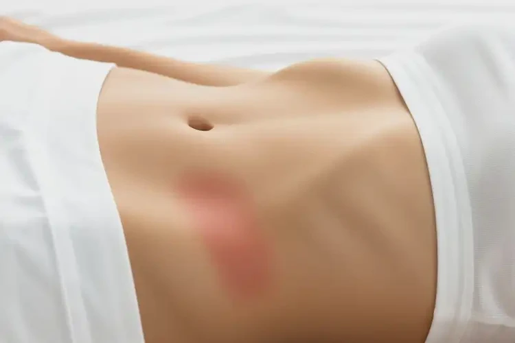 女人肚子上容易長(zhǎng)濕疹不管它會(huì)自己自愈嗎(圖4)