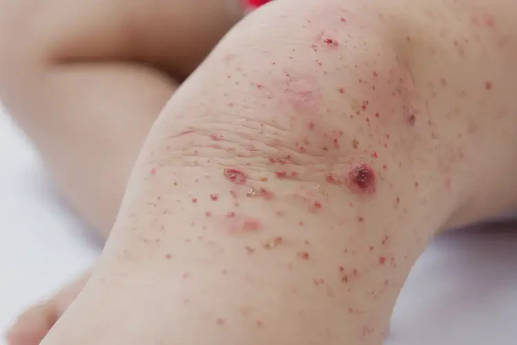 幼兒四肢起濕疹可以徹底自愈嗎(圖4)