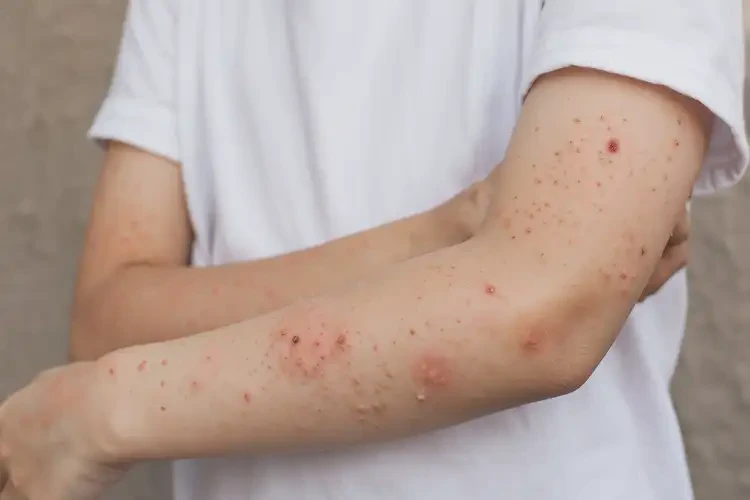 青少年手臂上經(jīng)常長濕疹不管它會自己痊愈嗎(圖4)