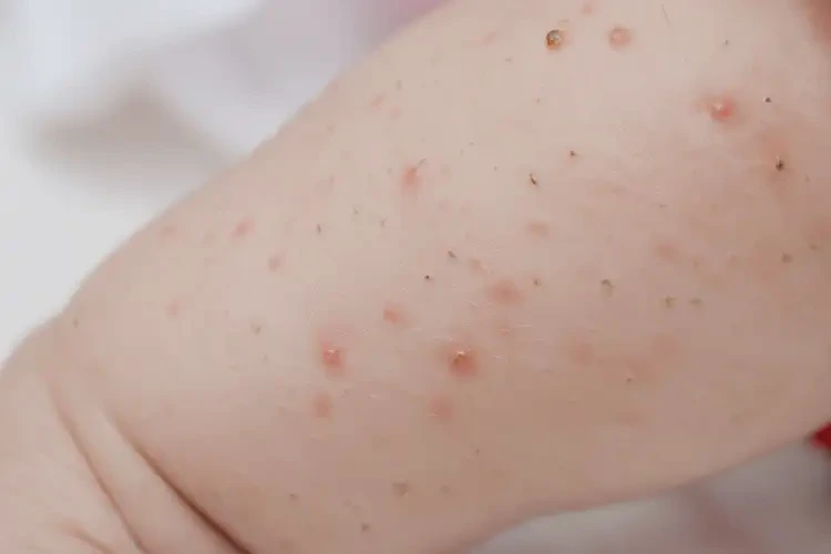 嬰兒小腿出濕疹不管它會自己好嗎(圖4)