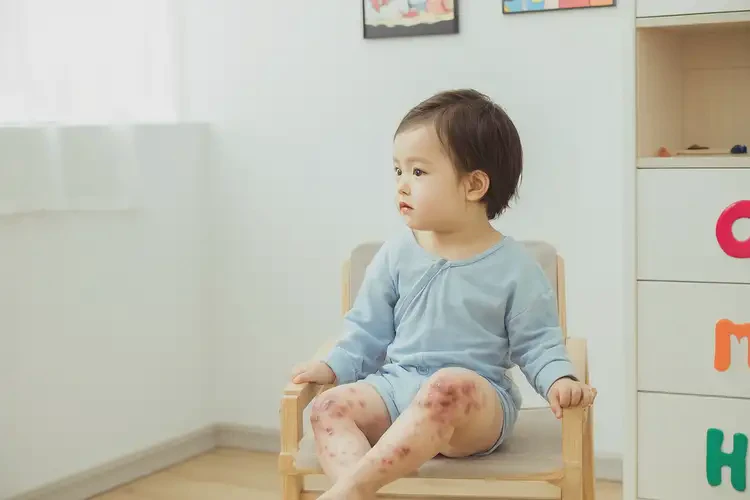 孩子大腿上经常长湿疹能彻底自愈吗(图2)