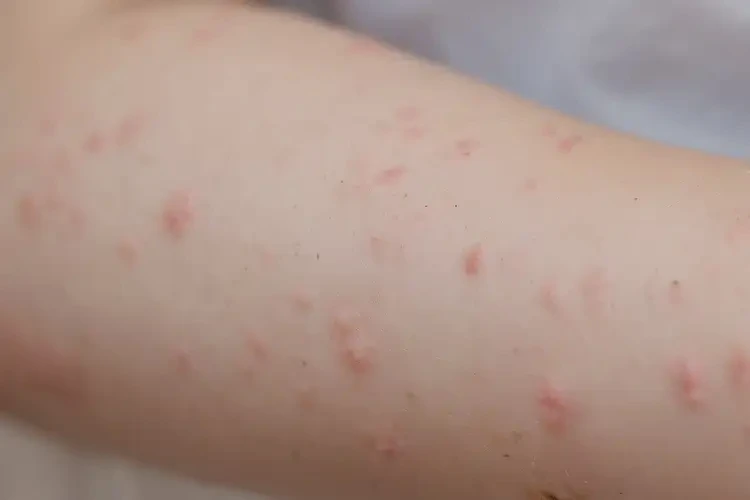 兒童手臂上出濕疹不管它會(huì)自己好嗎(圖4)