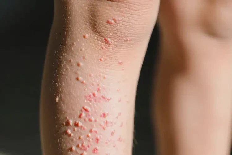 小孩小腿偶爾長(zhǎng)濕疹可不可以根治(圖1)