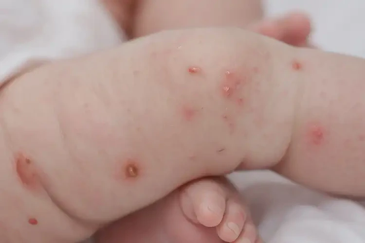 新生兒四肢容易長濕疹能徹底自愈嗎(圖4)