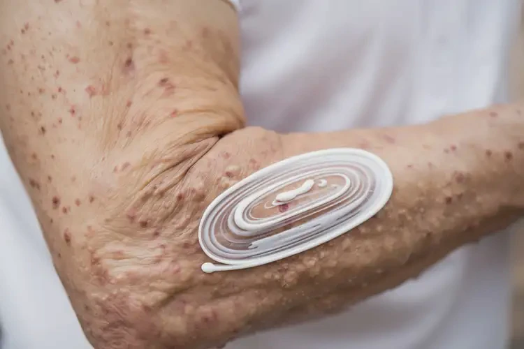 高齡老人手臂上有濕疹能不能根治(圖2)