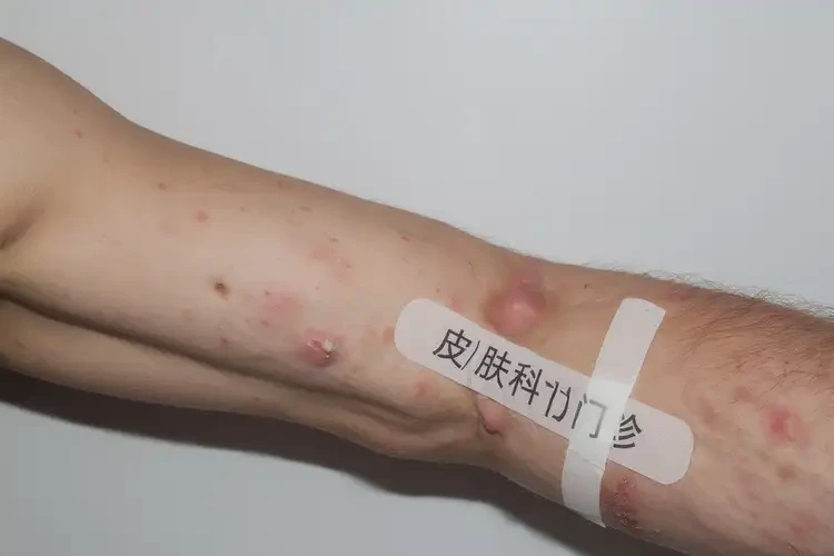 青年人手臂上出现湿疹可不可以彻底自愈(图4)