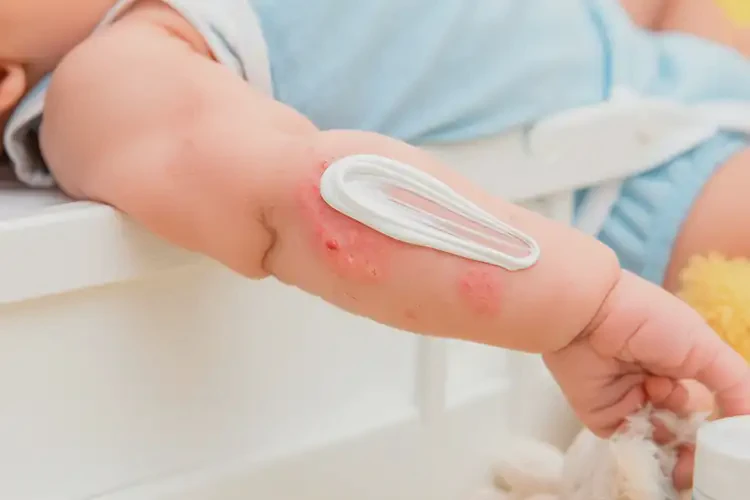 嬰幼兒手臂偶爾長濕疹可不可以根治(圖2)